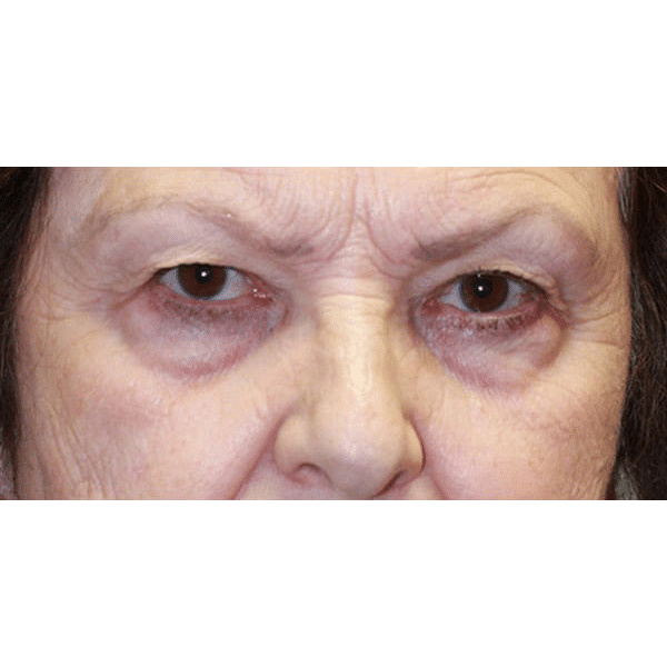 Before Image: Upper and Lower Blepharoplasty - front