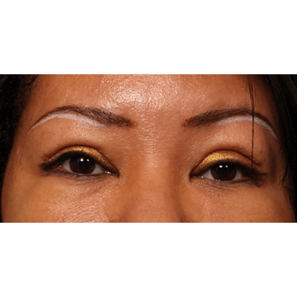 After Image: Upper Blepharoplasty and Ptosis Repair - front