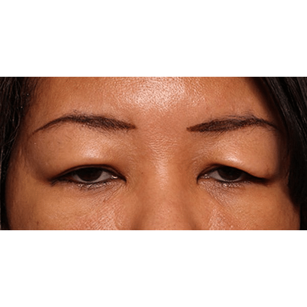 Before Image: Upper Blepharoplasty and Ptosis Repair - front