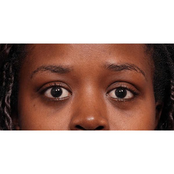 After Image: Graves Disease - front