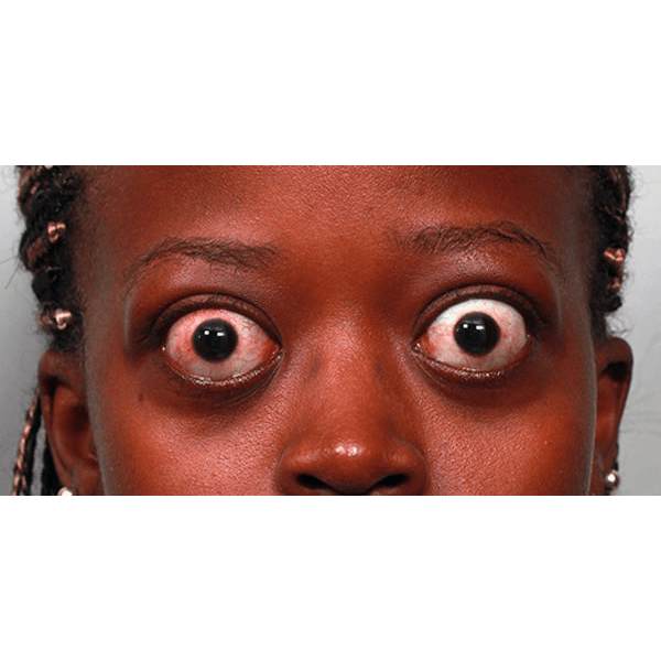 Before Image: Graves Disease - front