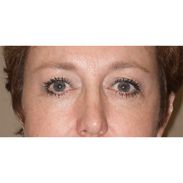 After Image: Endoscopic Browlift - front