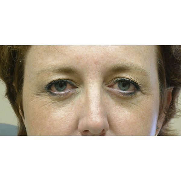 Before Image: Endoscopic Browlift - front