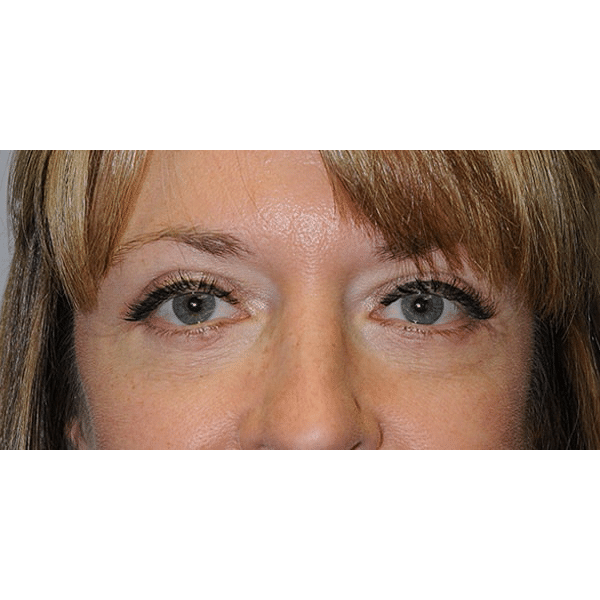 After Image: Upper & Lower Blepharoplasty - front