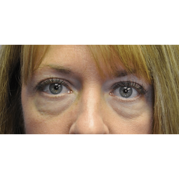 Before Image: Upper & Lower Blepharoplasty - front