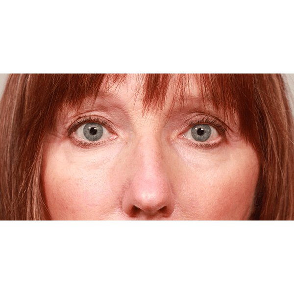 Before Image: Upper Blepharoplasty and Temporal Browlift - front