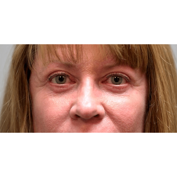 After Image: Upper and Lower Blepharoplasty - front