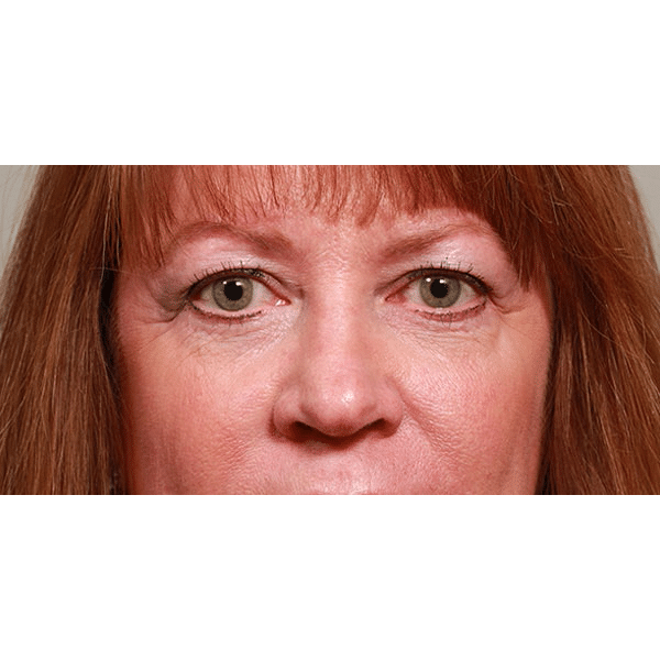 Before Image: Upper and Lower Blepharoplasty - front