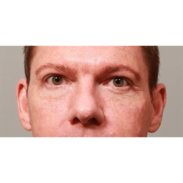 After Image: Upper & Lower Blepharoplasty - front
