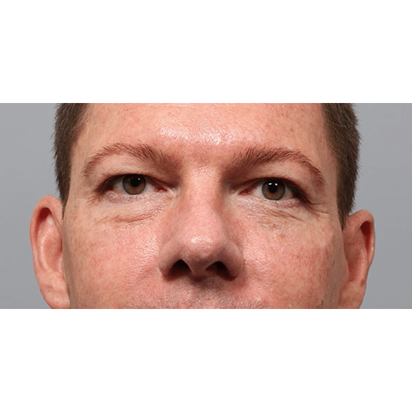 Before Image: Upper & Lower Blepharoplasty - front