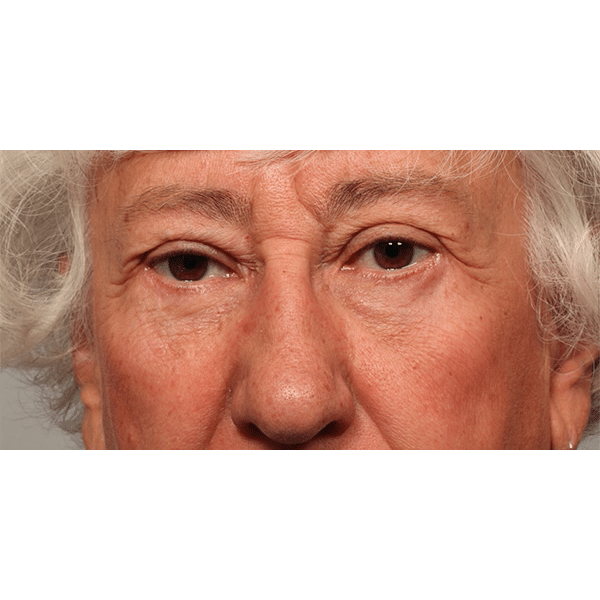 After Image: Upper & Lower Blepharoplasty - front