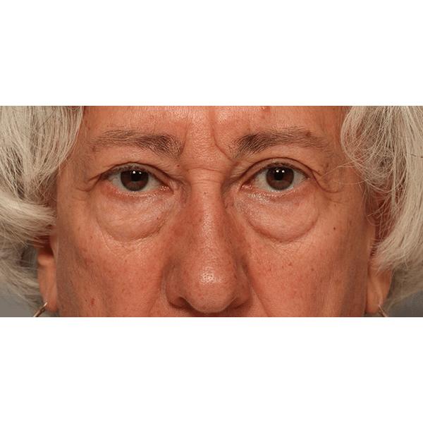 Before Image: Upper & Lower Blepharoplasty - front
