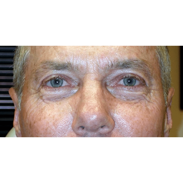 After Image: Upper Blepharoplasty - front
