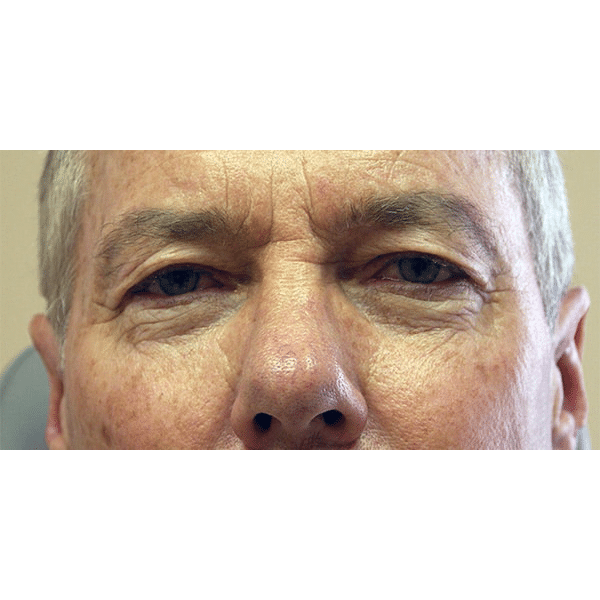 Before Image: Upper Blepharoplasty - front