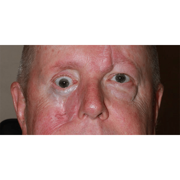 Before Image: Facial Reconstruction - front