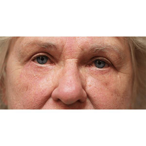 After Image: Upper & Lower Blepharoplasty - front