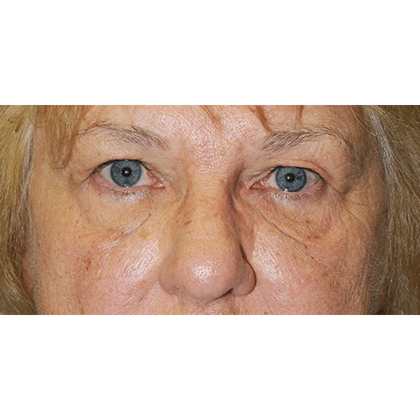 Before Image: Upper & Lower Blepharoplasty - front