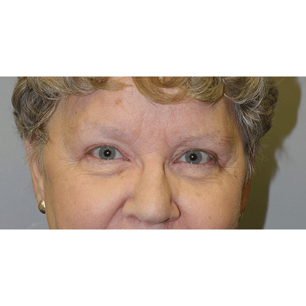 After Image: Upper Blepharoplasty and Ptosis Repair - front