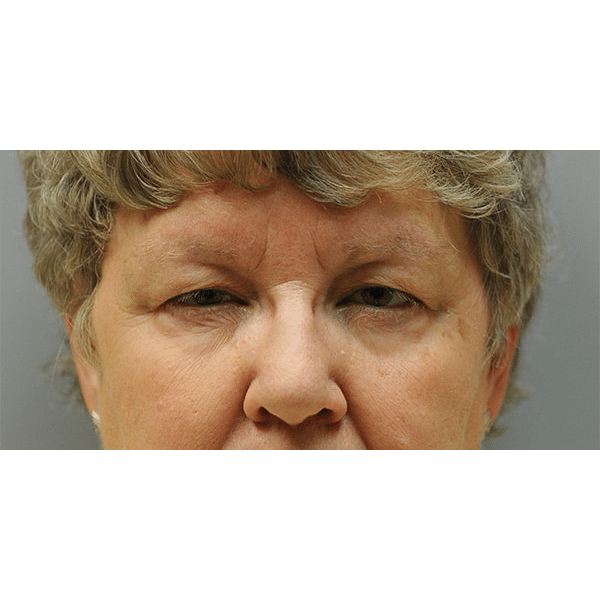 Before Image: Upper Blepharoplasty and Ptosis Repair - front