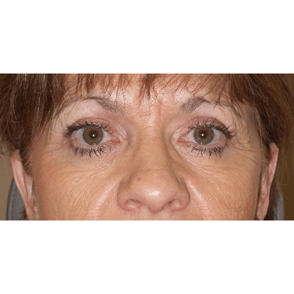 After Image: Right Ptosis Repair - front