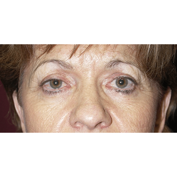 Before Image: Right Ptosis Repair - front