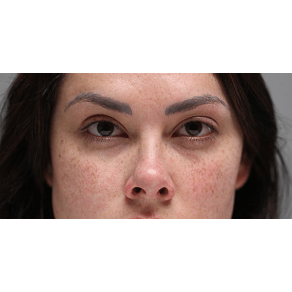 After Image: Ptosis Repair - front