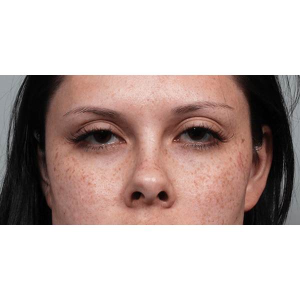 Before Image: Ptosis Repair - front