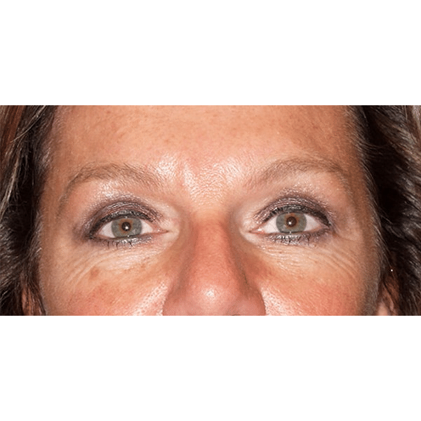 After Image: Upper & Lower Blepharoplasty - front