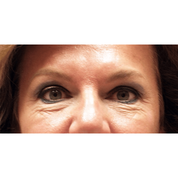 Before Image: Upper & Lower Blepharoplasty - front