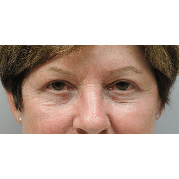 After Image: Upper & Lower Blepharoplasty - front