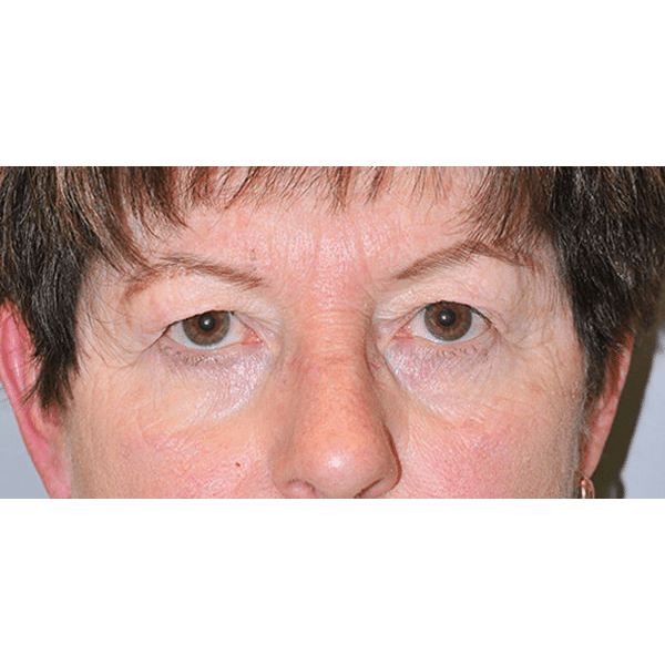 Before Image: Upper & Lower Blepharoplasty - front