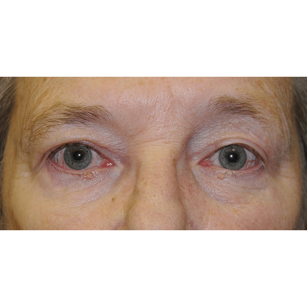 After Image: Upper Blepharoplasty and Ptosis Repair - front