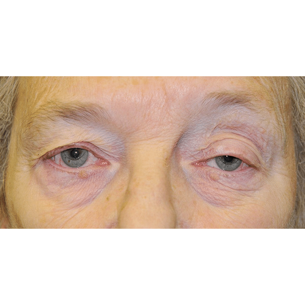 Before Image: Upper Blepharoplasty and Ptosis Repair - front