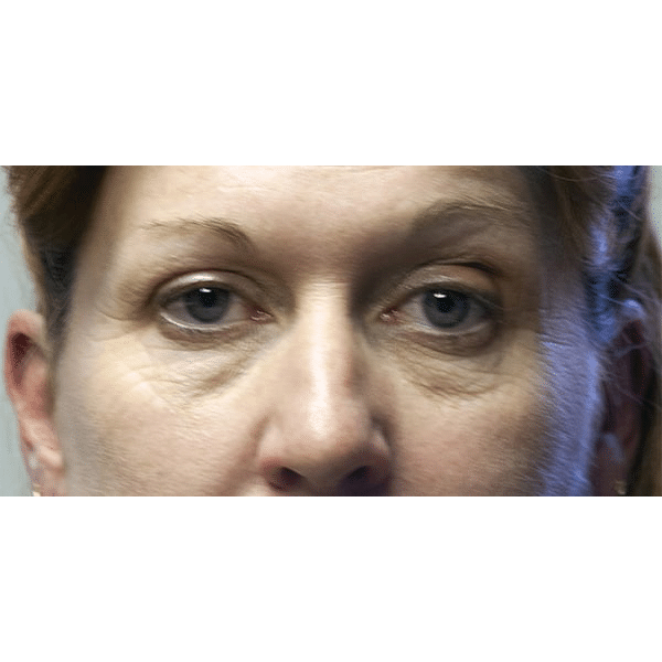 Before Image: Upper & Lower Blepharoplasty - front