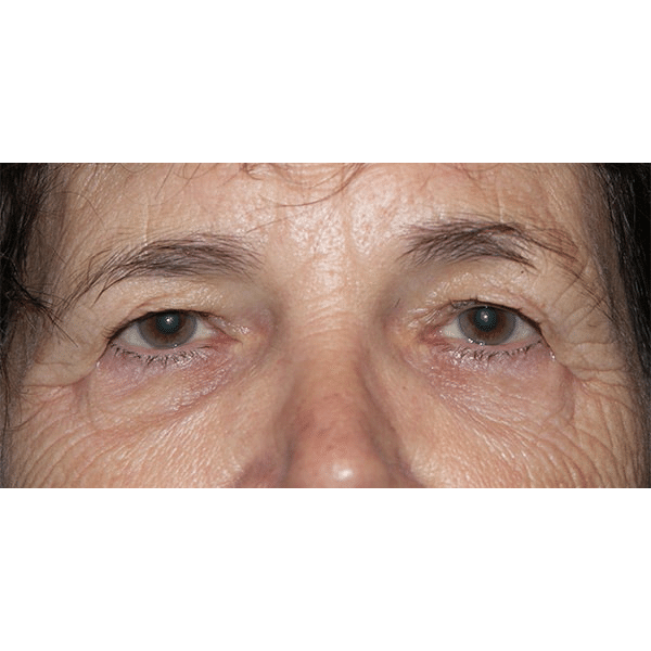 After Image: Upper Blepharoplasty and Endoscopic Browlift - front