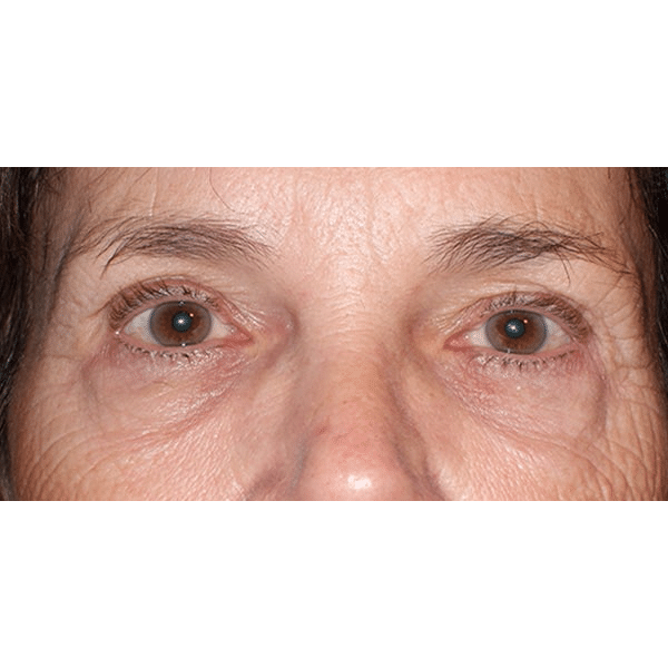 Before Image: Upper Blepharoplasty and Endoscopic Browlift - front