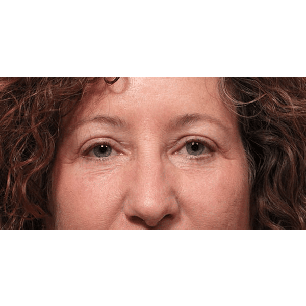 After Image: Upper and Lower Blepharoplasty - front