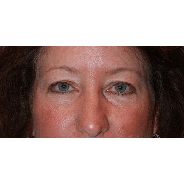 Before Image: Upper and Lower Blepharoplasty - front
