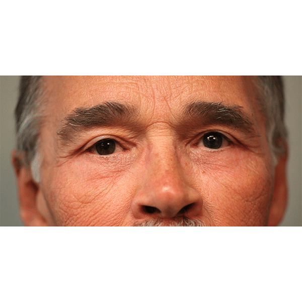 After Image: Upper & Lower Blepharoplasty - front