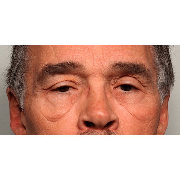 Before Image: Upper & Lower Blepharoplasty - front
