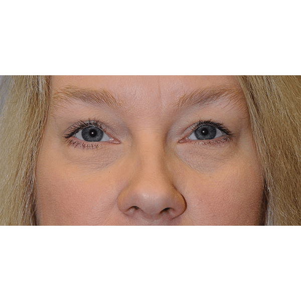 After Image: Ptosis Repair - front