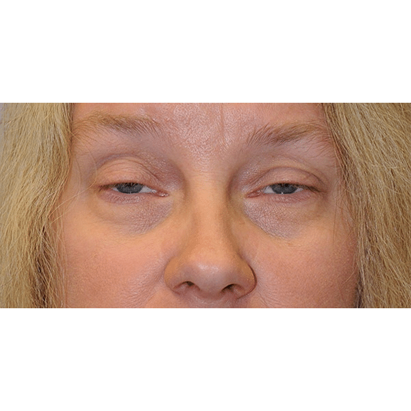 Before Image: Ptosis Repair - front
