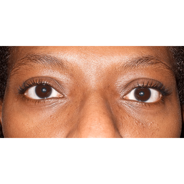 After Image: Orbital Decompression - front