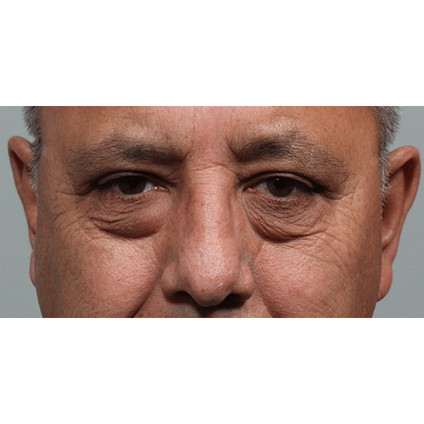 After Image: Upper Blepharoplasty - front