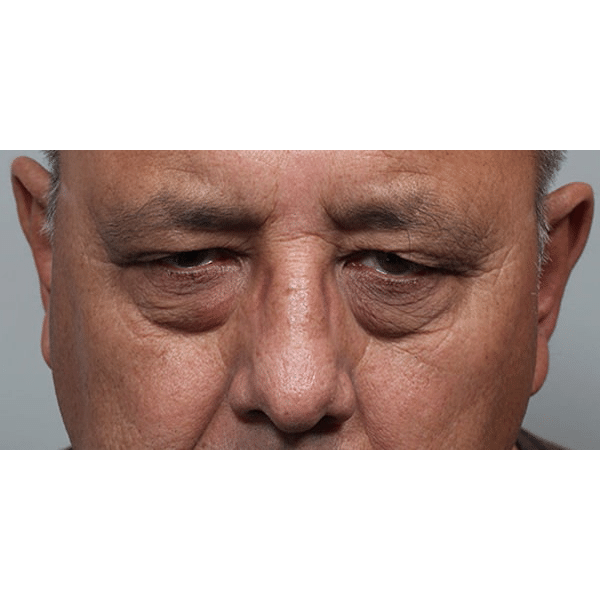 Before Image: Upper Blepharoplasty - front
