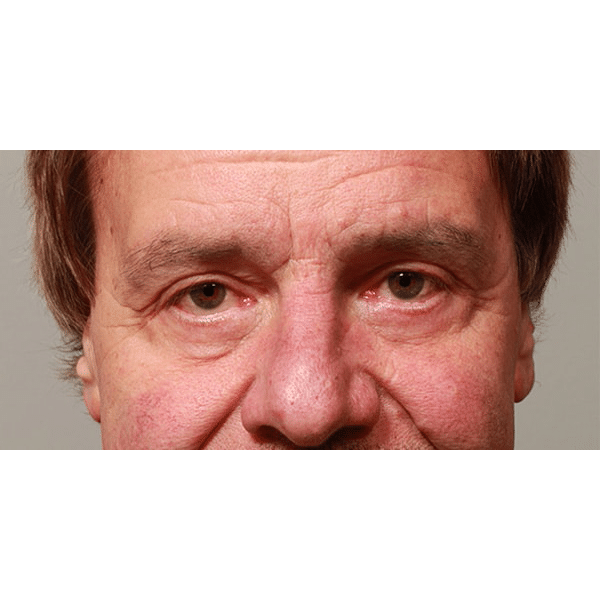 After Image: Upper and Lower Blepharoplasty - front