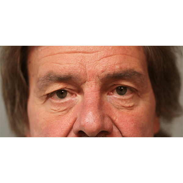 Before Image: Upper and Lower Blepharoplasty - front