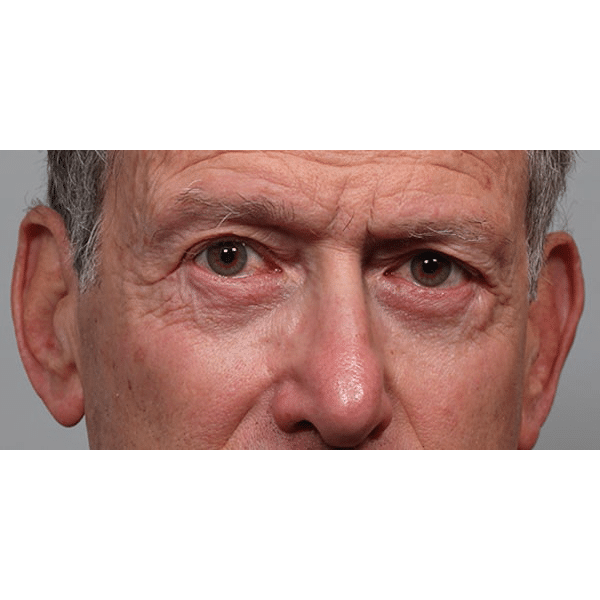 After Image: Lower Blepharoplasty - front