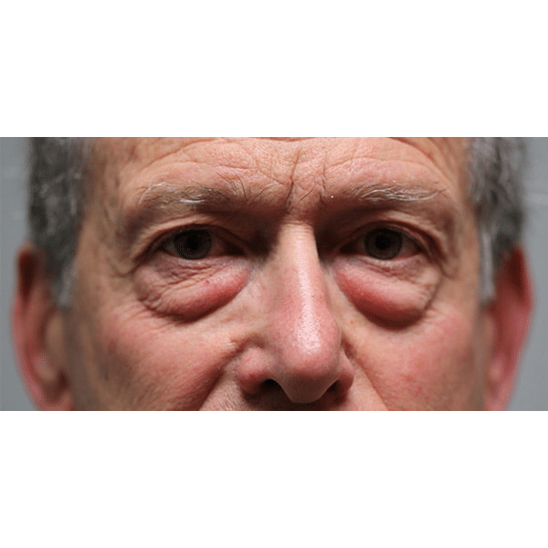 Before Image: Lower Blepharoplasty - front