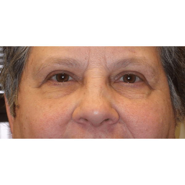 After Image: Upper Blepharoplasty - front